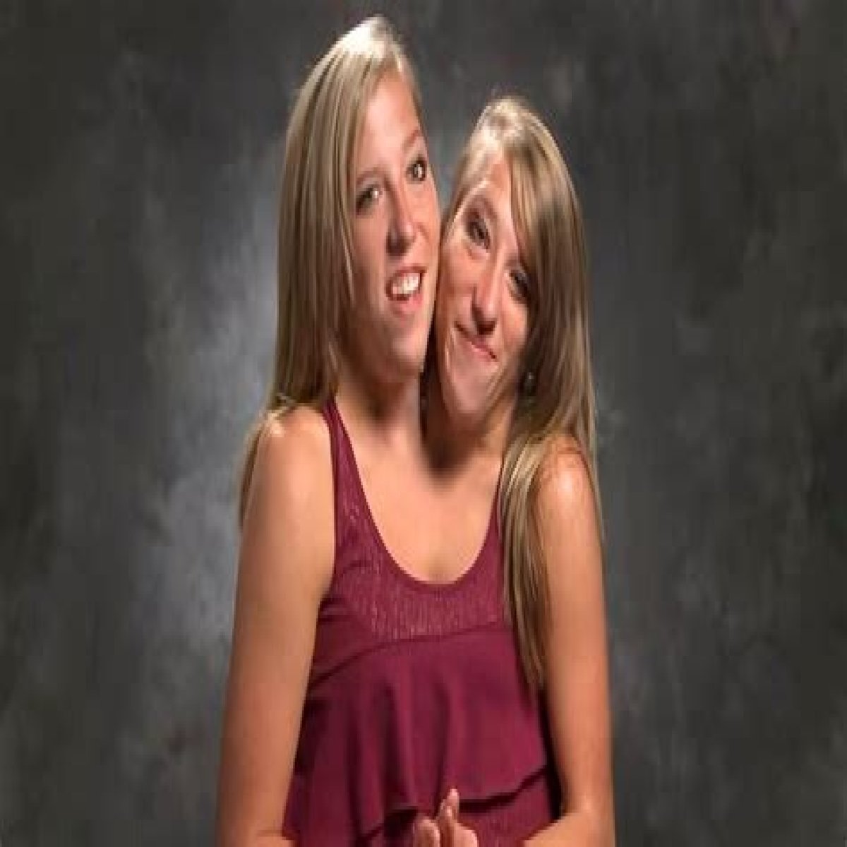 Are Abby and Brittany Hensel still conjoined?