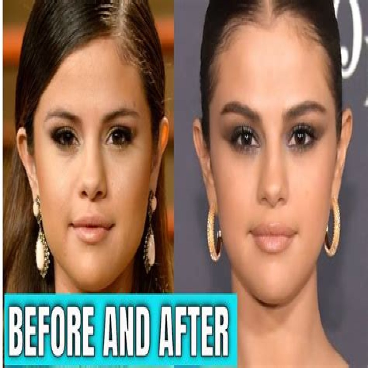 Did Selena Gomez Get a Boob Job? Here’s Why Two Plastic Surgery Experts Think Yes