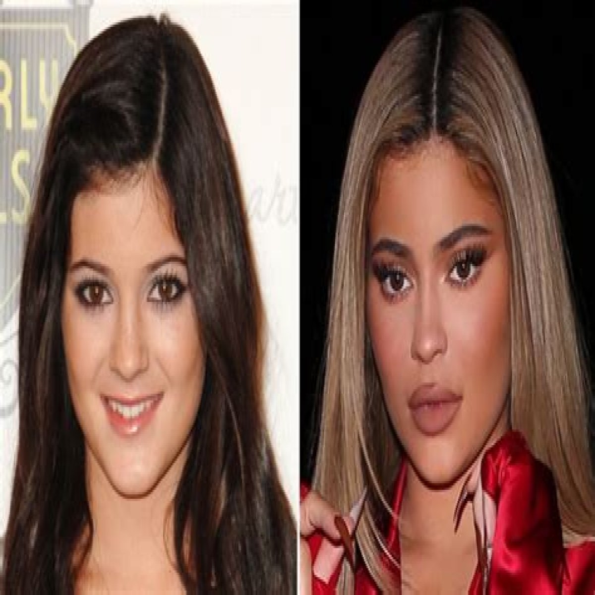 Kylie Jenner Is No Stranger to Plastic Surgery: Her Transformation Before and After Lip Fillers