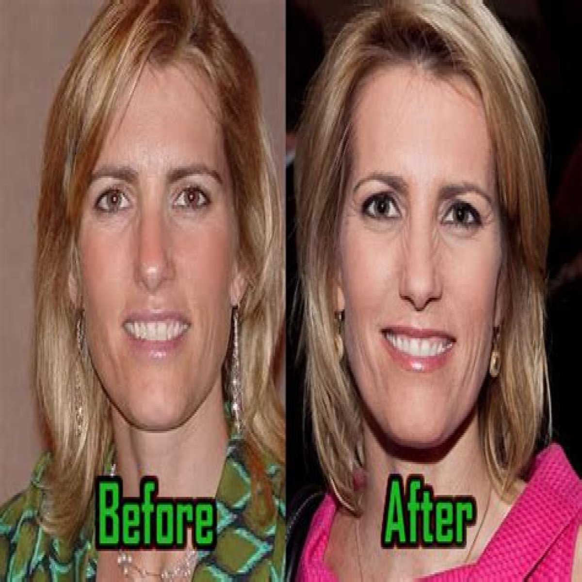 What Happened To Laura Ingraham Face? Face Life and Plastic Surgery Update